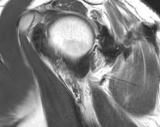 Figure 5 for case Stab wound